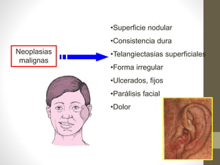 Neoplasias
malignas
•Superficie nodular
•Consistencia dura
•Telangiectasias superficiales
•Forma irregular
•Ulcerados, fijos
•Parálisis facial
•Dolor
 