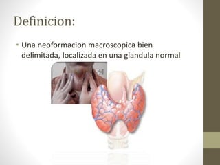 Definicion:
• Una neoformacion macroscopica bien
delimitada, localizada en una glandula normal
 