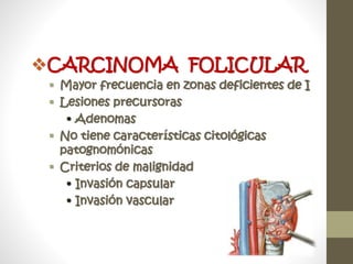 CARCINOMA FOLICULAR
 Mayor frecuencia en zonas deficientes de I
 Lesiones precursoras
• Adenomas
 No tiene características citológicas
patognomónicas
 Criterios de malignidad
• Invasión capsular
• Invasión vascular
 