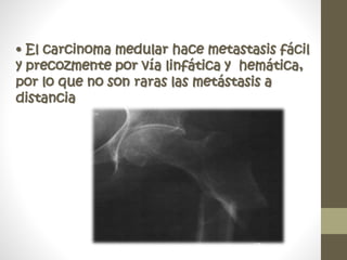 • El carcinoma medular hace metastasis fácil
y precozmente por vía linfática y hemática,
por lo que no son raras las metástasis a
distancia
 
