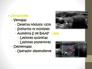 • Ultrasonido
• Ventajas
• Detecta nódulos <1cm
• Solitarios vs múltiples
• Aumenta S de BAAF >98%
• Lesiones quísticas
• Lesiones posteriores
• Desventajas
• Operador dependiente
 