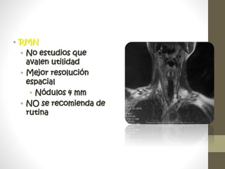 • RMN
• No estudios que
avalen utilidad
• Mejor resolución
espacial
• Nódulos 4 mm
• NO se recomienda de
rutina
 