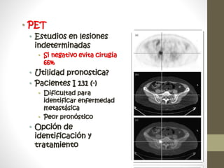 • PET
• Estudios en lesiones
indeterminadas
• Si negativo evita cirugía
66%
• Utilidad pronostica?
• Pacientes I 131 (-)
• Dificultad para
identificar enfermedad
metastásica
• Peor pronóstico
• Opción de
identificación y
tratamiento
 
