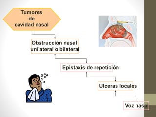 Tumores
de
cavidad nasal
Obstrucción nasal
unilateral o bilateral
Epistaxis de repetición
Ulceras locales
Voz nasal
 