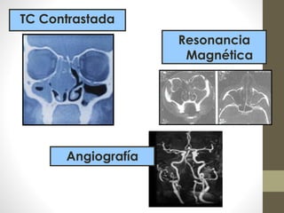 TC Contrastada
Resonancia
Magnética
Angiografía
 