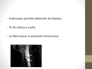 • Endoscopia permite obtención de biopsias
• TC de cabeza y cuello
• La IRM evaluar la extensión intracraneal
 