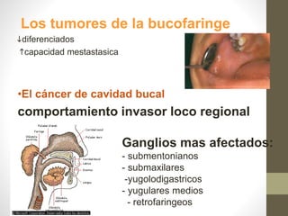 Los tumores de la bucofaringe
diferenciados
capacidad mestastasica
Ganglios mas afectados:
- submentonianos
- submaxilares
-yugolodigastricos
- yugulares medios
- retrofaringeos
•El cáncer de cavidad bucal
comportamiento invasor loco regional
 