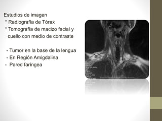 Estudios de imagen
* Radiografía de Tórax
* Tomografía de macizo facial y
cuello con medio de contraste
- Tumor en la base de la lengua
- En Región Amigdalina
- Pared faríngea
 