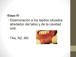 • Etapa IV
• Diseminación a los tejidos situados
alrededor del labio y de la cavidad
oral.
• T4a, N2, M0
 