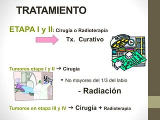 TRATAMIENTO
ETAPA I y II: Cirugía o Radioterapia
Tx. Curativo
Tumores etapa I y II  Cirugía
- No mayores del 1/3 del labio
- Radiación
Tumores en etapa III y IV  Cirugía + Radioterapia
 
