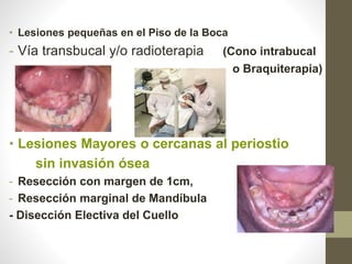• Lesiones pequeñas en el Piso de la Boca
- Vía transbucal y/o radioterapia (Cono intrabucal
o Braquiterapia)
• Lesiones Mayores o cercanas al periostio
sin invasión ósea
- Resección con margen de 1cm,
- Resección marginal de Mandíbula
- Disección Electiva del Cuello
 