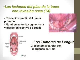 Los Tumores de Lengua
Glosectomía parcial con
márgenes de 1 cm
- Resección amplia del tumor
primario
- Mandibulectomía segmentaria
y disección electiva de cuello
•Las lesiones del piso de la boca
con invasión ósea (T4)
 