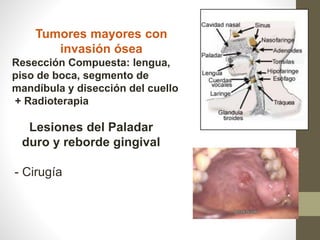 Tumores mayores con
invasión ósea
Resección Compuesta: lengua,
piso de boca, segmento de
mandíbula y disección del cuello
+ Radioterapia
Lesiones del Paladar
duro y reborde gingival
- Cirugía
 