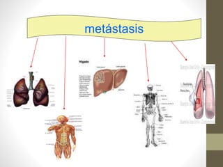 metástasis
 