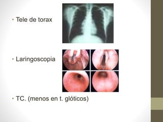 • Tele de torax
• Laringoscopia
• TC. (menos en t. glóticos)
 