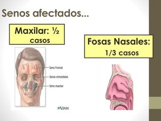 Senos afectados...
Maxilar: ½
casos Fosas Nasales:
1/3 casos
 