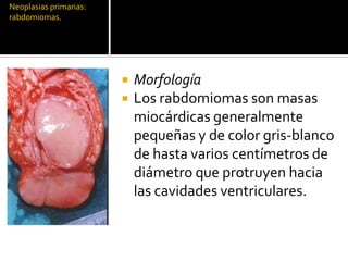 Tumores cardiacos Slide 12
