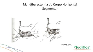 Mandibulectomia do Corpo Horizontal
Segmentar
BOJRAB, 1996.
 