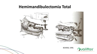 Hemimandibulectomia Total
BOJRAB, 1996.
 