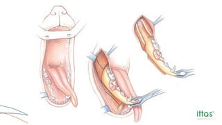 Hemimandibulectomia Total
BOJRAB, 1996.
 