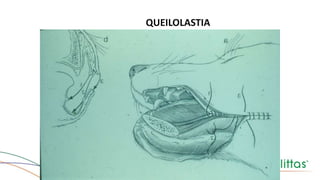 QUEILOLASTIA
 
