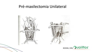 Pré-maxilectomia Unilateral
BOJRAB, 1996.
 