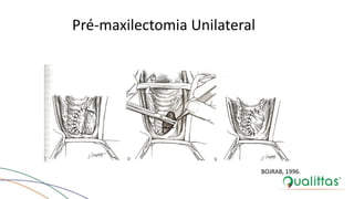 Pré-maxilectomia Unilateral
BOJRAB, 1996.
 