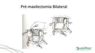 Pré-maxilectomia Bilateral
BOJRAB, 1996.
 