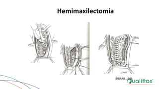 Hemimaxilectomia
BOJRAB, 1996.
 