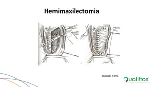 Hemimaxilectomia
BOJRAB, 1996.
 