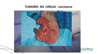 TUMORES NA LINGUA - carcinoma
 