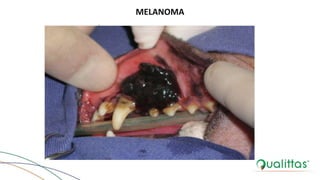 melanoma
MELANOMA
 