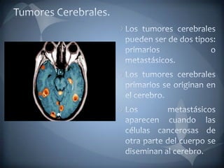 Tumores Cerebrales.Los tumores cerebrales pueden ser de dos tipos: primarios o metastásicos.Los tumores cerebrales primarios se originan en el cerebro.Los metastásicos aparecen cuando las células cancerosas de otra parte del cuerpo se diseminan al cerebro. 