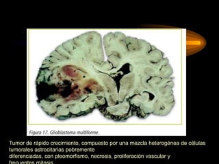Tumor de rápido crecimiento, compuesto por una mezcla heterogénea de células
tumorales astrocitarias pobremente
diferenciadas, con pleomorfismo, necrosis, proliferación vascular y
 