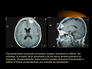 Frecuentemente comprimen el cerebro, aunque raramente lo infiltran. Sin
embargo, la invasión de la duramadre y de los senos durales próximos es
frecuente. Ocasionalmente, estos tumores pueden atravesar la duramadre e
infiltrar el hueso, produciéndose una reacción de hiperóstosis
 