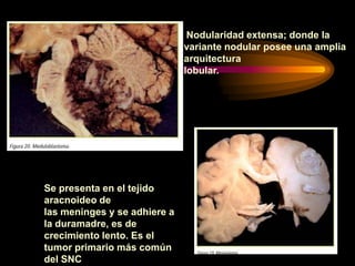 Nodularidad extensa; donde la
variante nodular posee una amplia
arquitectura
lobular.
Se presenta en el tejido
aracnoideo de
las meninges y se adhiere a
la duramadre, es de
crecimiento lento. Es el
tumor primario más común
del SNC
 