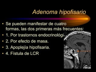 Adenoma hipofisario
• Se pueden manifestar de cuatro
formas, las dos primeras más frecuentes:
• 1. Por trastornos endocrinológicos
• 2. Por efecto de masa.
• 3. Apoplejía hipofisaria.
• 4. Fístula de LCR
 