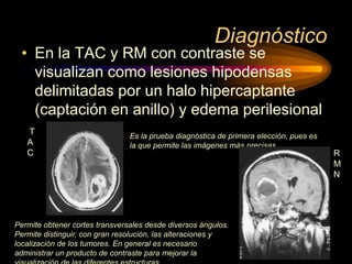 Diagnóstico
• En la TAC y RM con contraste se
visualizan como lesiones hipodensas
delimitadas por un halo hipercaptante
(captación en anillo) y edema perilesional
T
A
C
Permite obtener cortes transversales desde diversos ángulos.
Permite distinguir, con gran resolución, las alteraciones y
localización de los tumores. En general es necesario
administrar un producto de contraste para mejorar la
Es la prueba diagnóstica de primera elección, pues es
la que permite las imágenes más precisas
R
M
N
 