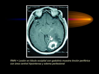 RMN = Lesión en lóbulo occipital con gadolinio muestra tinción periférica
con área central hipointensa y edema perilesional
 