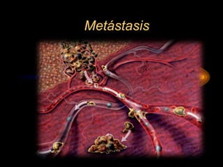 Metástasis
 