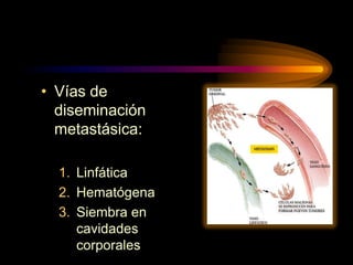 • Vías de
diseminación
metastásica:
1. Linfática
2. Hematógena
3. Siembra en
cavidades
corporales
 