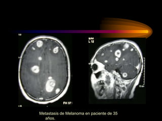 Metastasis de Melanoma en paciente de 35
años.
 