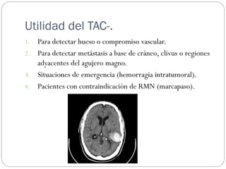 Utilidad del TAC-.
1. Para detectar hueso o compromiso vascular.
2. Para detectar metástasis a base de cráneo, clivus o re...