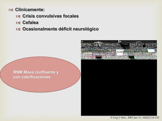 Tumores cerebrales | PPTX