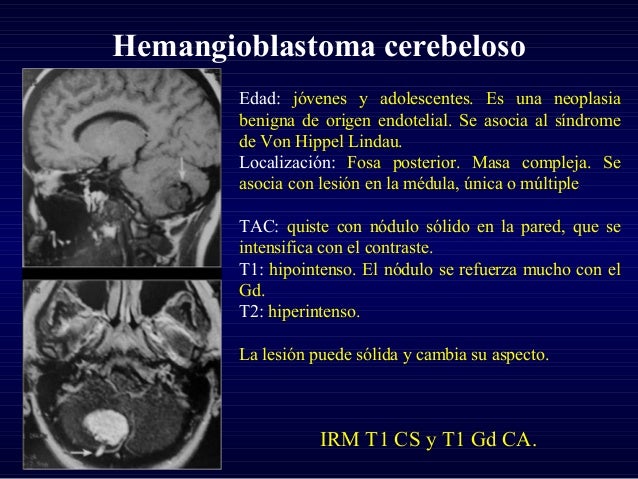 sintomas de tumores cerebrales en jovenes