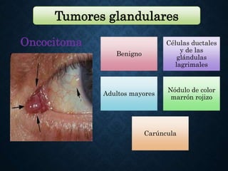 TUMORES CONJUNTIVALES BENIGNOS Y MALIGNOS.pptx