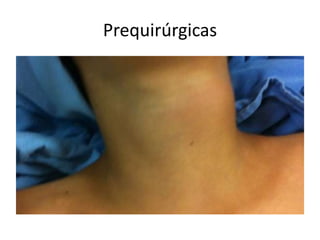 Prequirúrgicas
 