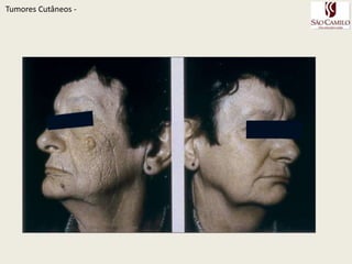 TumoresCutâneos - 