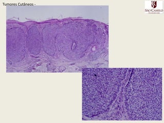 Fatores ExtrínsecosTumoresCutâneos - Radiação ionizanteRaios X, motivos ocupacionais e terapêuticosCarcinógenos químicosCoaltar, asfalto, fuligem, ceras parafinadas, óleos de corte, lubrificantes;Arsênio + sol ( 18-45 anos) múltipos CBC e CECsPUVA + psoralênico > risco 2,6 XPapilomavírus humano : HPV 16 e 18CEC anogenital, periungueal e em transplantados