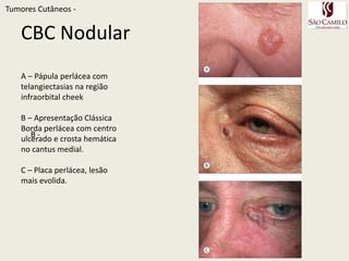 TumoresCutâneos - 